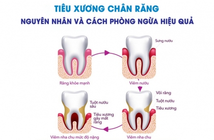 Tiêu Xương Chân Răng - Hiểu Rõ Căn Bệnh Và Cách Phòng Ngừa
